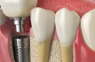 Helpful Pointers As You Prepare For Dental Implant Surgery